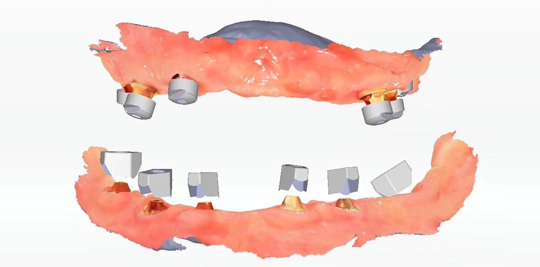 Scanner Intro oral - Aoralscan Elite -Shining 3D