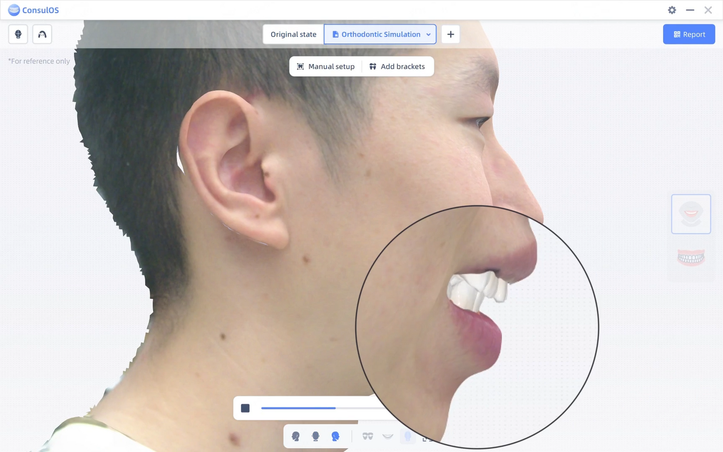MetiSmile -Scanner facial Shining 3D
